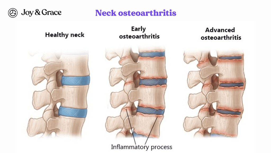 neck osteoarthritis