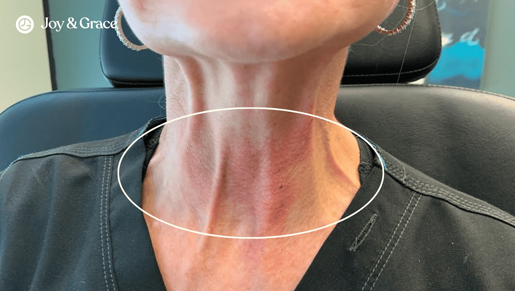 a woman with a swelling on her neck