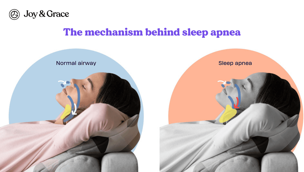 How to Sleep with Cervical Radiculopathy