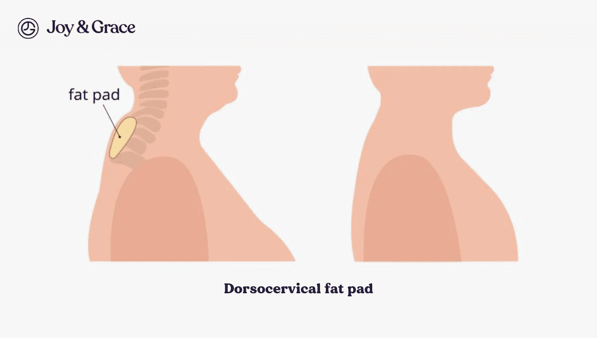 Understanding Pain In Neck Humps A Basic Guide