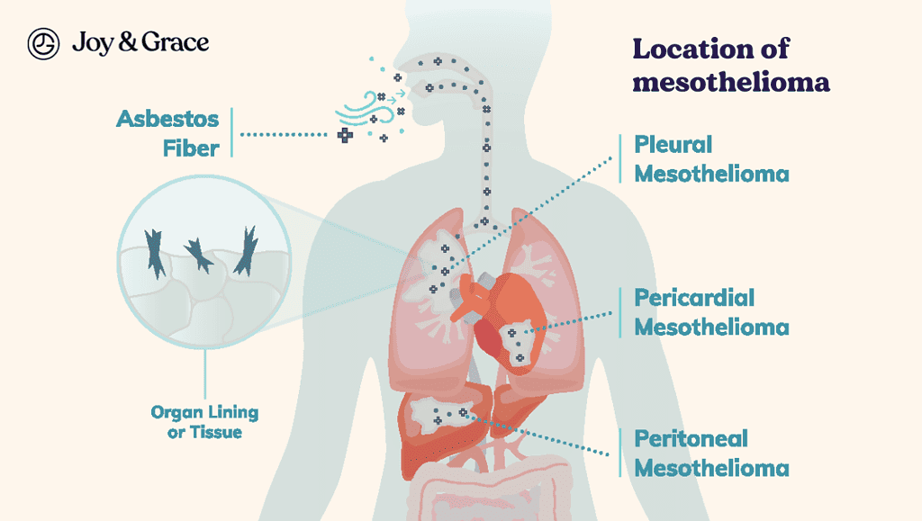 different location of mesothelioma