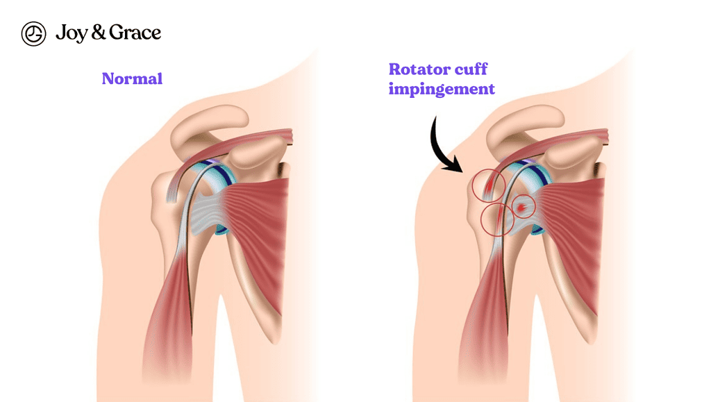 two pictures showing the normal and rotator cuff impingement