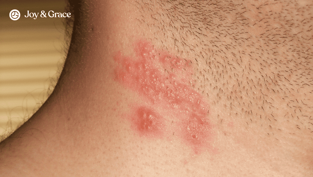 shingles rash on a neck of a person