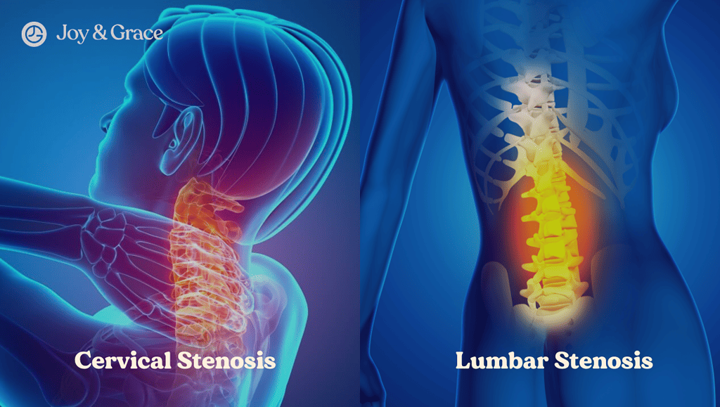 graphic illustration of cervical stenosis and lumbar stenosis