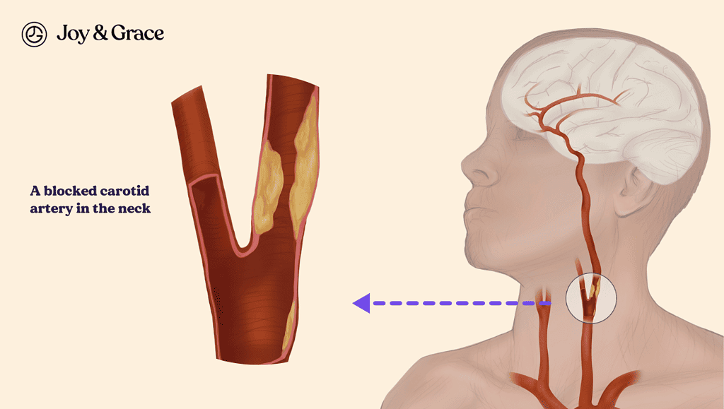 a graphic illustration of a blocked carotid artery in the neck