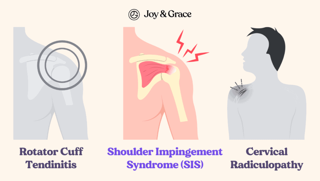 Shoulder impingement syndrome is a condition that causes pain and discomfort in the shoulder. It occurs when the tricep muscle becomes impinged, resulting in restricted movement and reduced range of motion