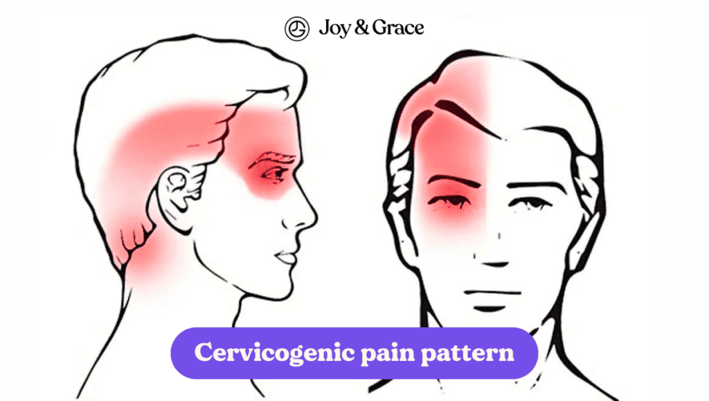 Cervicalgia pain pattern affecting the left side of the neck.