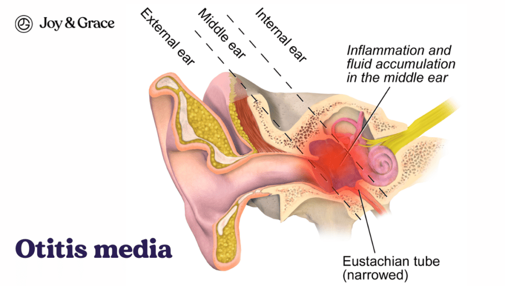 Otitis media, also known as a middle ear infection, can cause pain behind the ear.