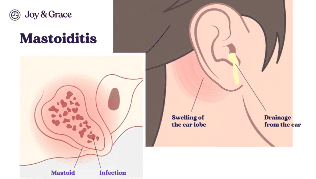 Mastoiditis: Symptoms, Pain, Treatment
