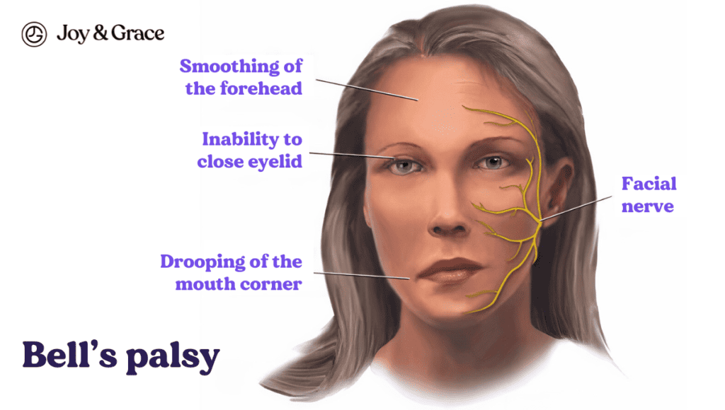 Bell's palsy is a condition that causes sudden paralysis or weakness of the facial muscles, resulting in difficulty in controlling facial movements. The pain and discomfort associated with Bell's palsy can manifest