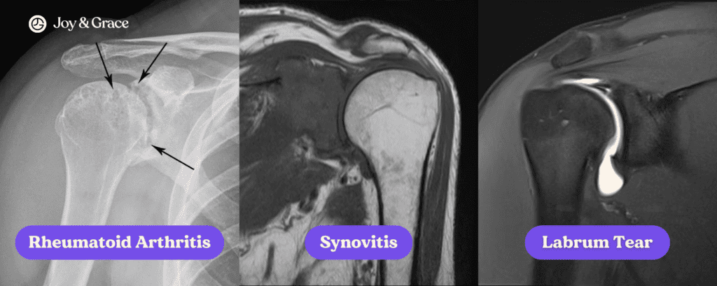 A series of x-rays examining chronic shoulder pain and potential causes and treatments.