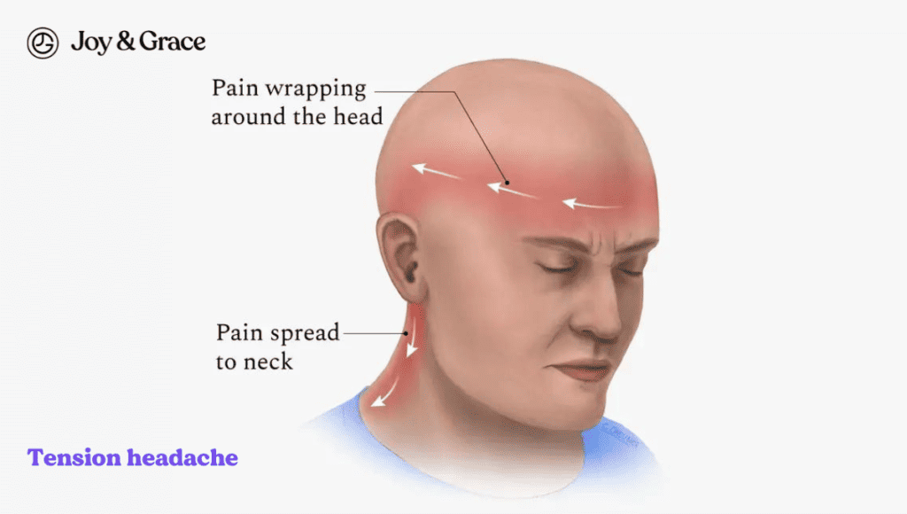 A diagram showing the symptoms of tension headache, including pain in the neck and on the left side.