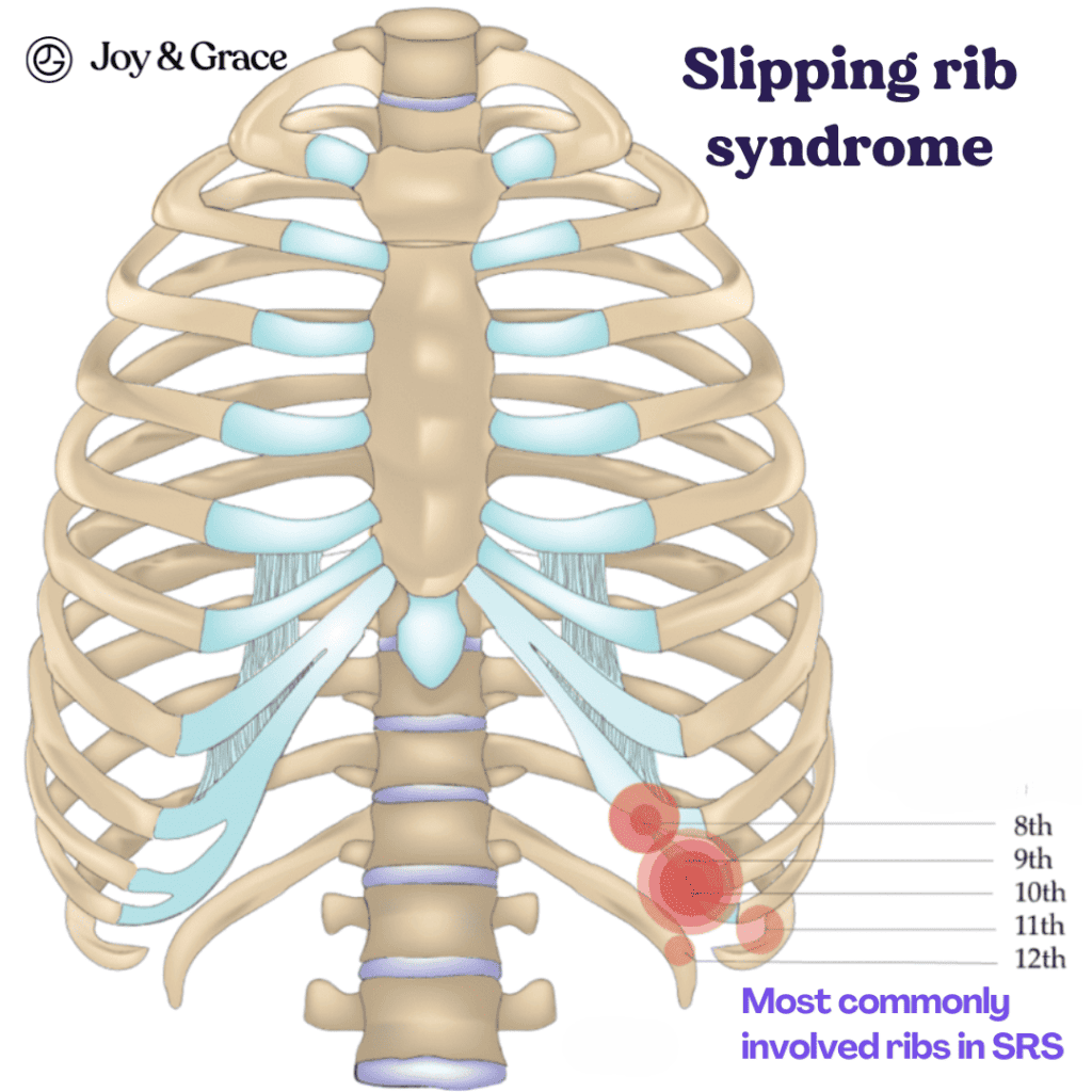 A diagram illustrating the symptoms of slipping rib syndrome, including shoulder and rib pain.