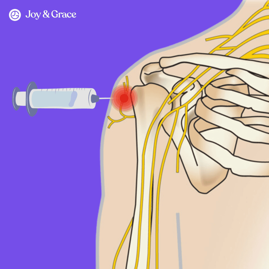 A syringe is being injected into a person's shoulder to alleviate shoulder pain or administer a tetanus shot.