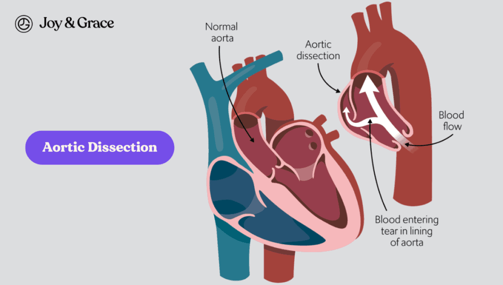 A schematic diagram illustrating the causes of aortic dissection and the associated stabbing pain near the shoulder blade.