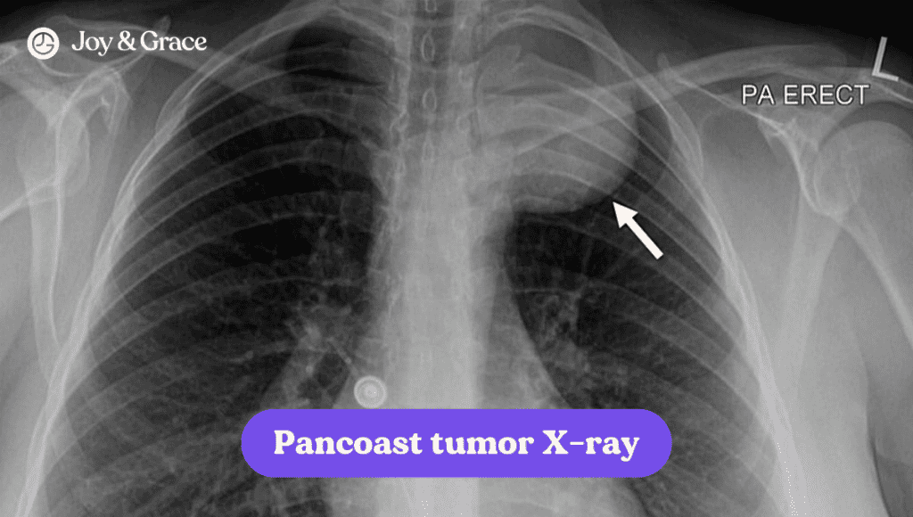 This x-ray image of a thorax reveals the bright white outline of the panasotum, with no visible abnormalities. The patient may be experiencing stabbing pain in the back of shoulder.