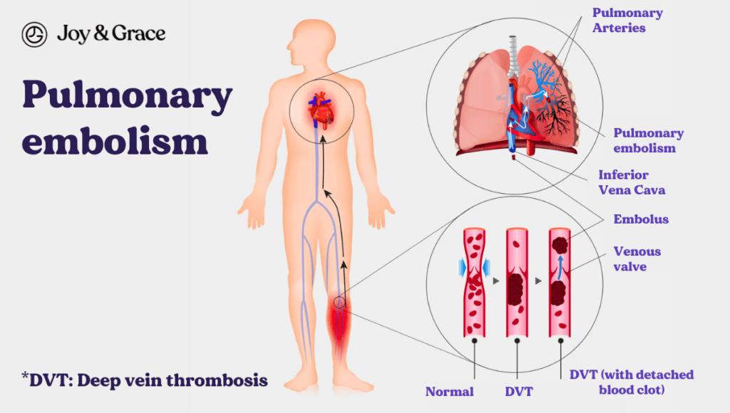 Pulmonary embolism can cause stabbing pain in the back, particularly under the left shoulder blade.