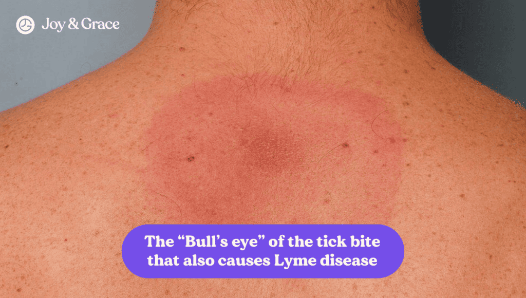 The bull's eye of the tick bite that causes lyme disease is often accompanied by burning pain. However, understanding the causes and solutions of this condition can help alleviate symptoms and prevent further complications