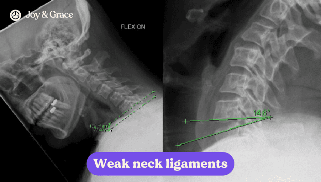 Two x-rays revealing weak neck alignments, potentially indicating neck pain and the possibility of high blood pressure.