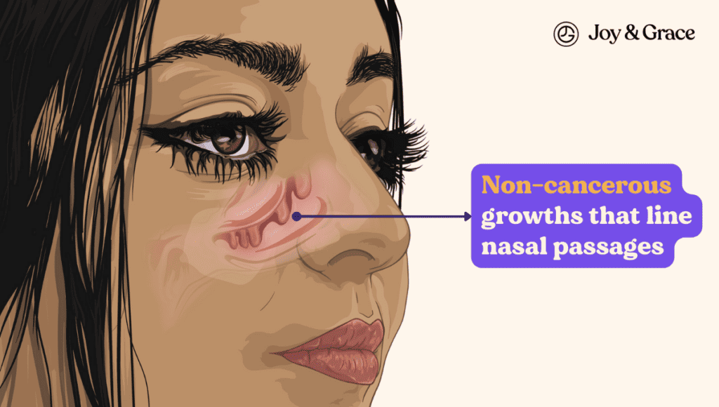 No cancerous growths that line nasal passages can cause sinus infections.